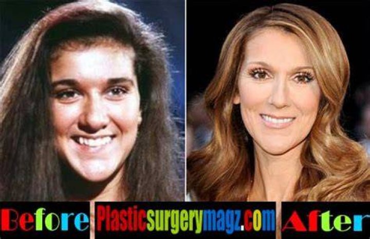 Celine Dion Nose Job Plastic Surgery Before and After