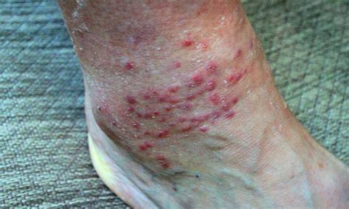 Chigger Bite Treatment Outdoor Life