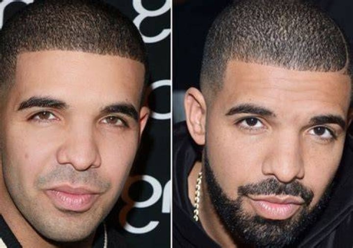 Drake Plastic Surgery Has The Rapper Obtained BBL and Lipo? Reddit