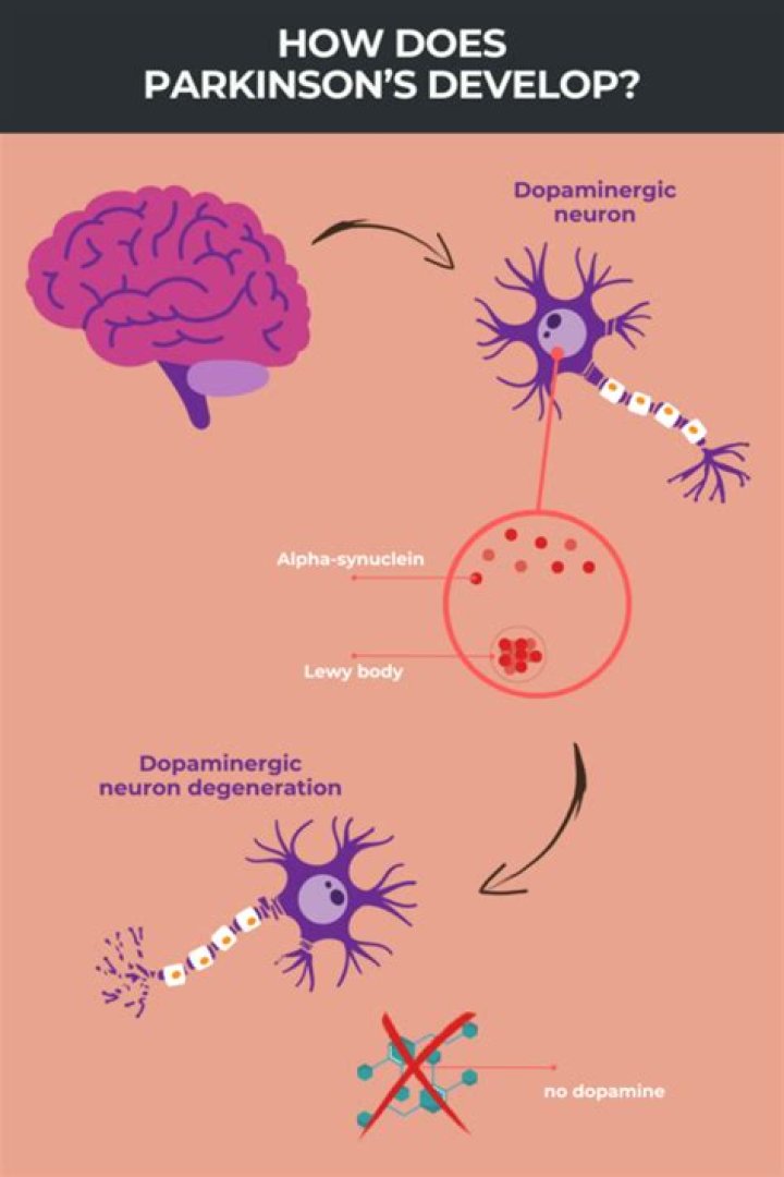 How Does Parkinson's Disease Affect The Brain