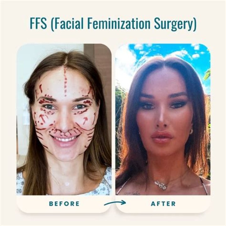 Joyce before and after FFS 2pass Clinic