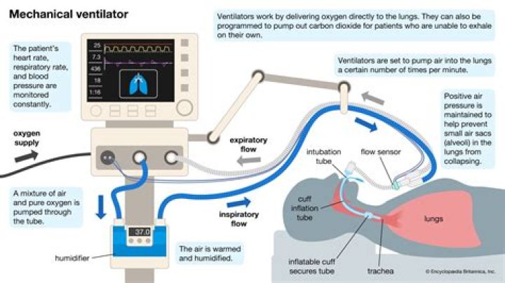Simplifying Mechanical Ventilation Part 2 Goals of Mechanical